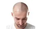 affordable hair transplant
