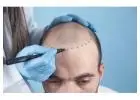 Hair Transplant in Islamabad