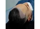 FUE Hair Transplant in Islamabad