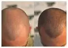 Scalp Micropigmentation in Islamabad