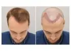 Hair Transplant in Islamabad