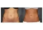 Liposuction in Islamabad