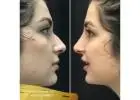 Best Clinic for Rhinoplasty in Islamabad