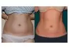 Tummy Tuck in Islamabad for Firm and Flat Abdomen
