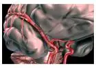 What Treatment Options Are Available for Stroke Hemorrhagic?